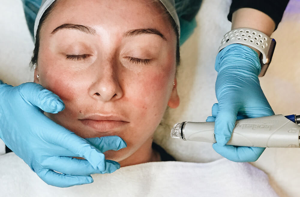 HydraFacial® for Multiple Skin Blemishes