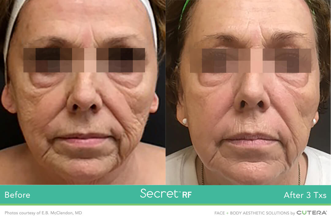 SECRET™ RF