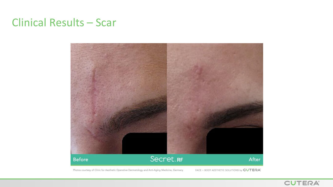 MICRO-NEEDLING SECRET™ RF