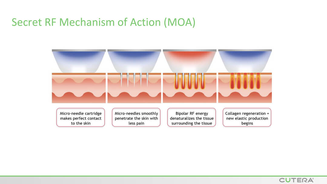 MICRO-NEEDLING SECRET™ RF