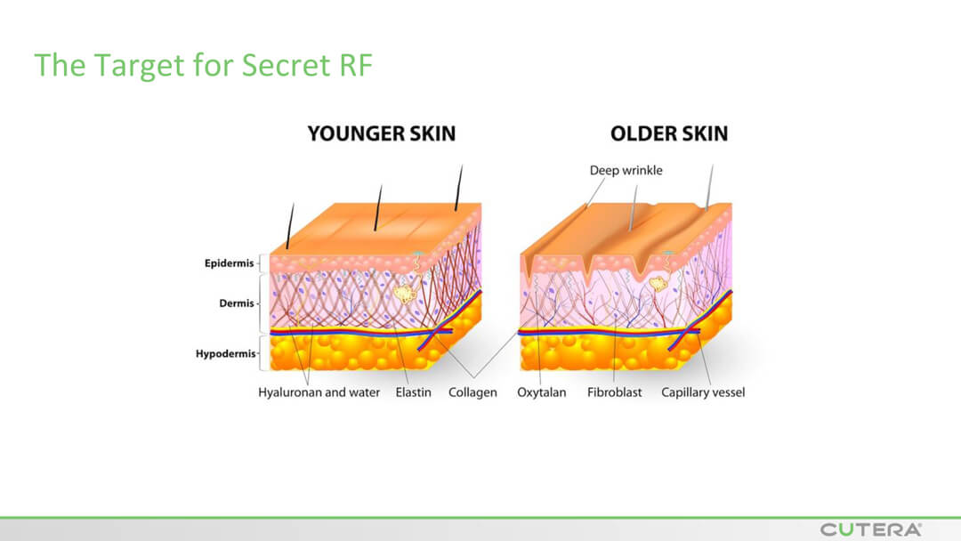 MICRO-NEEDLING SECRET™ RF