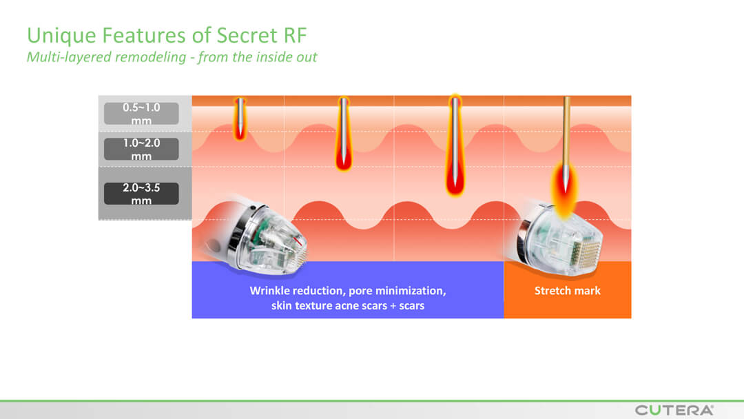 MICRO-NEEDLING SECRET™ RF