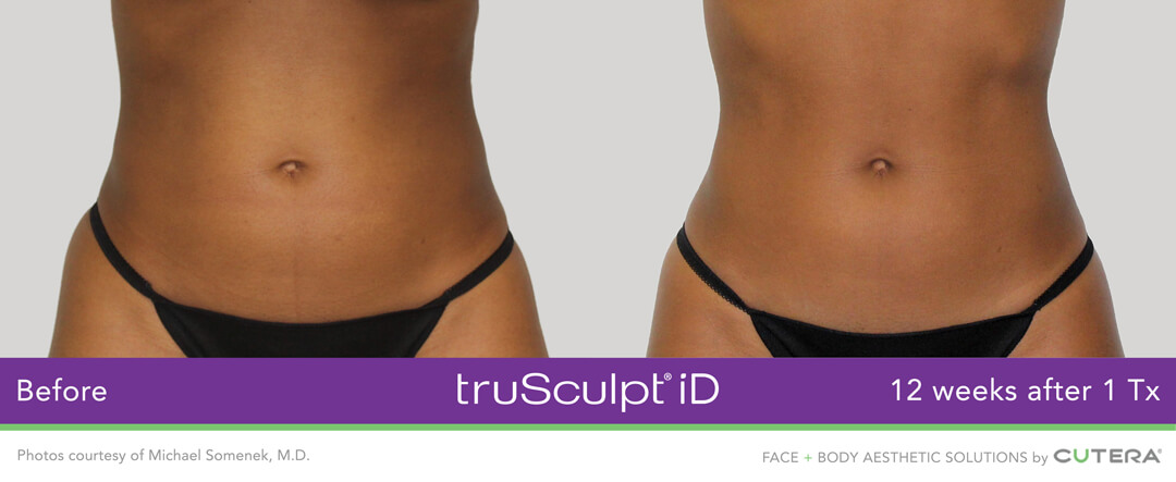 TRUSCULPT® ID