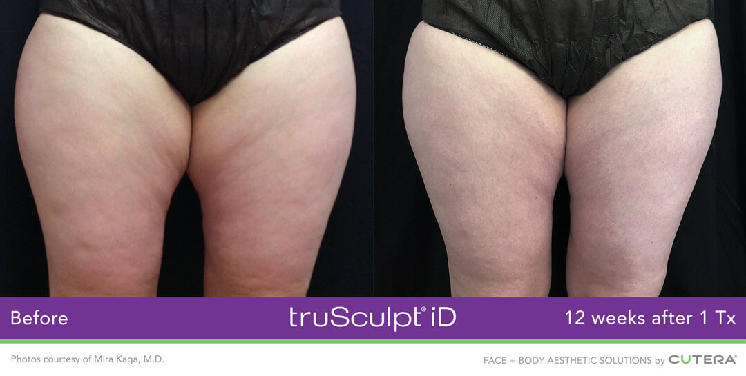 TRUSCULPT® ID