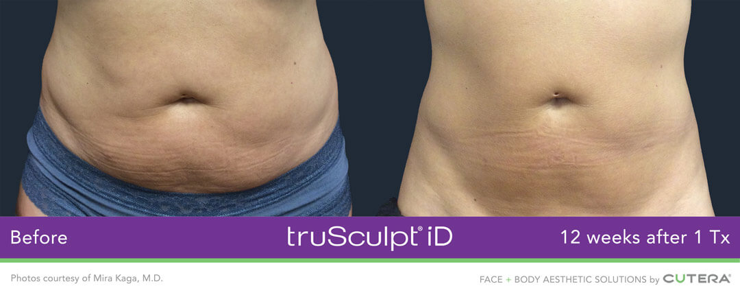 TRUSCULPT® ID