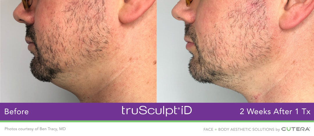 TRUSCULPT® ID