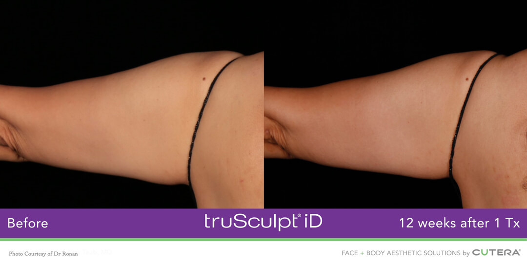 TRUSCULPT® ID