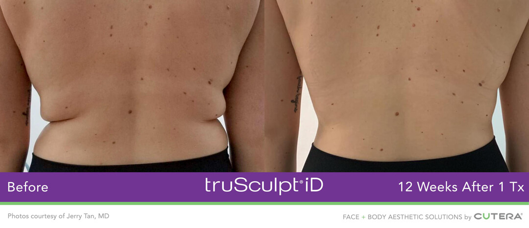 TRUSCULPT® ID