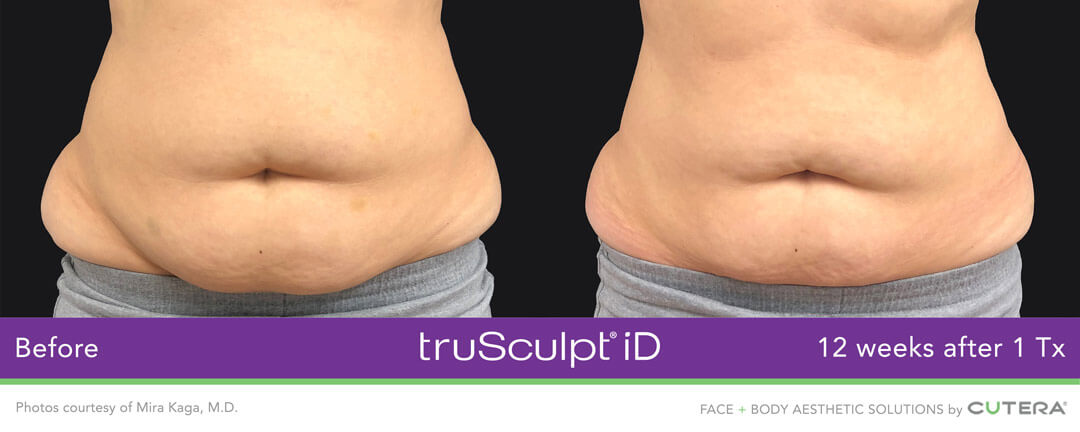 TRUSCULPT® ID